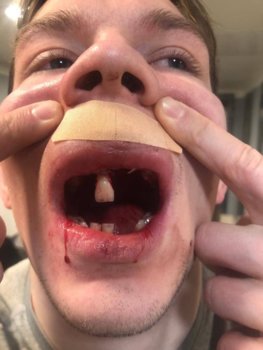 Лютая жесть в российском хоккее. Радулов сломал сопернику лицо и выбил почти все зубы